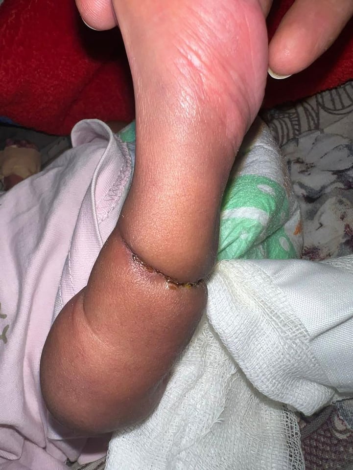 Neonatal leg with a circumferential constricting band and an associated clubfoot deformity