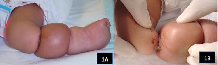 Infant right lower limb with two constriction bands causing distal lymphoedema and a close-up showing full-thickness skin loss at the proximal ring