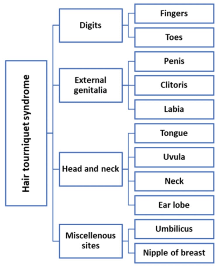 Table of anatomical sites affected by hair tourniquet syndrome including digits, head and neck structures and miscellaneous sites