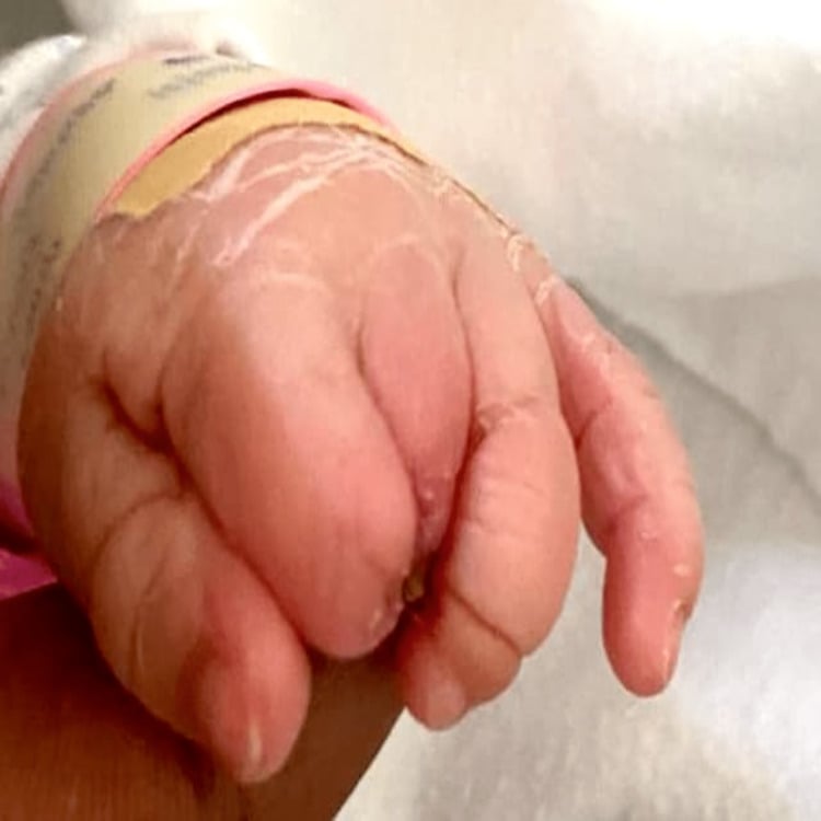 Dorsal view of an infant left hand showing absent distal phalanges of the index and long fingers with a superficial band on the ring finger