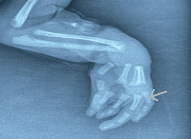 Radiograph of an infant left hand showing a shortened proximal phalanx of the middle finger