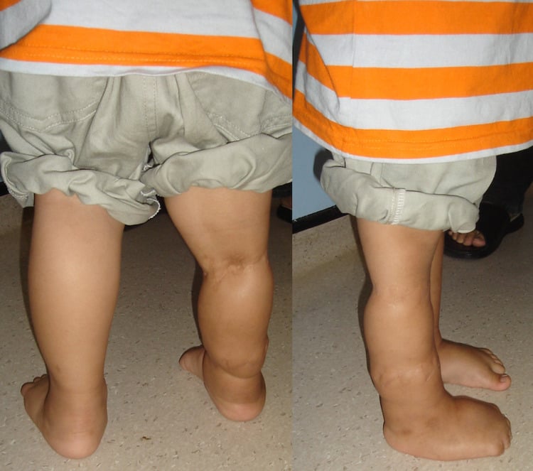 Photograph of both legs at two years of age showing resolution of the previous limb oedema