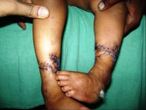 Postoperative photograph of both lower limbs after Z-plasty release of constriction bands