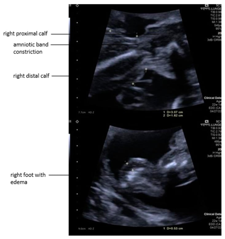 Prenatal ultrasound labelling an amniotic band constricting the right calf with the distal calf and an oedematous right foot