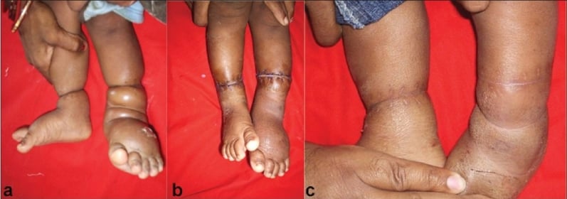Clinical photographs of bilateral lower limb constriction bands before surgery, at three weeks and at one year after release