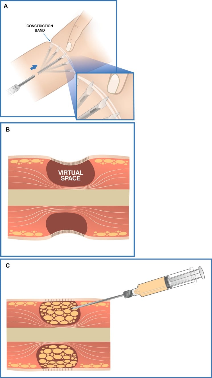 Schematic of the release sequence showing perpendicular cuts on the inner surface of the band, creation of a subcutaneous space, then fat grafting