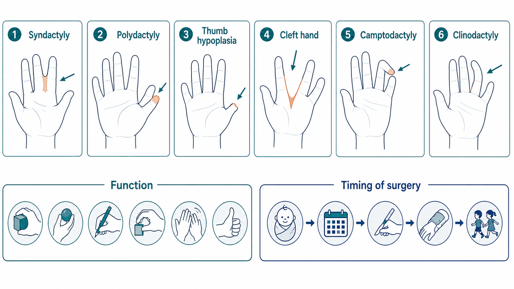 Congenital hand anomalies overview showing syndactyly, polydactyly, thumb hypoplasia, cleft hand, camptodactyly and clinodactyly
