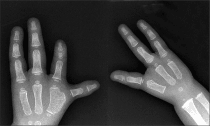 Child with upper limb deficiency and hypoplastic thumb pattern