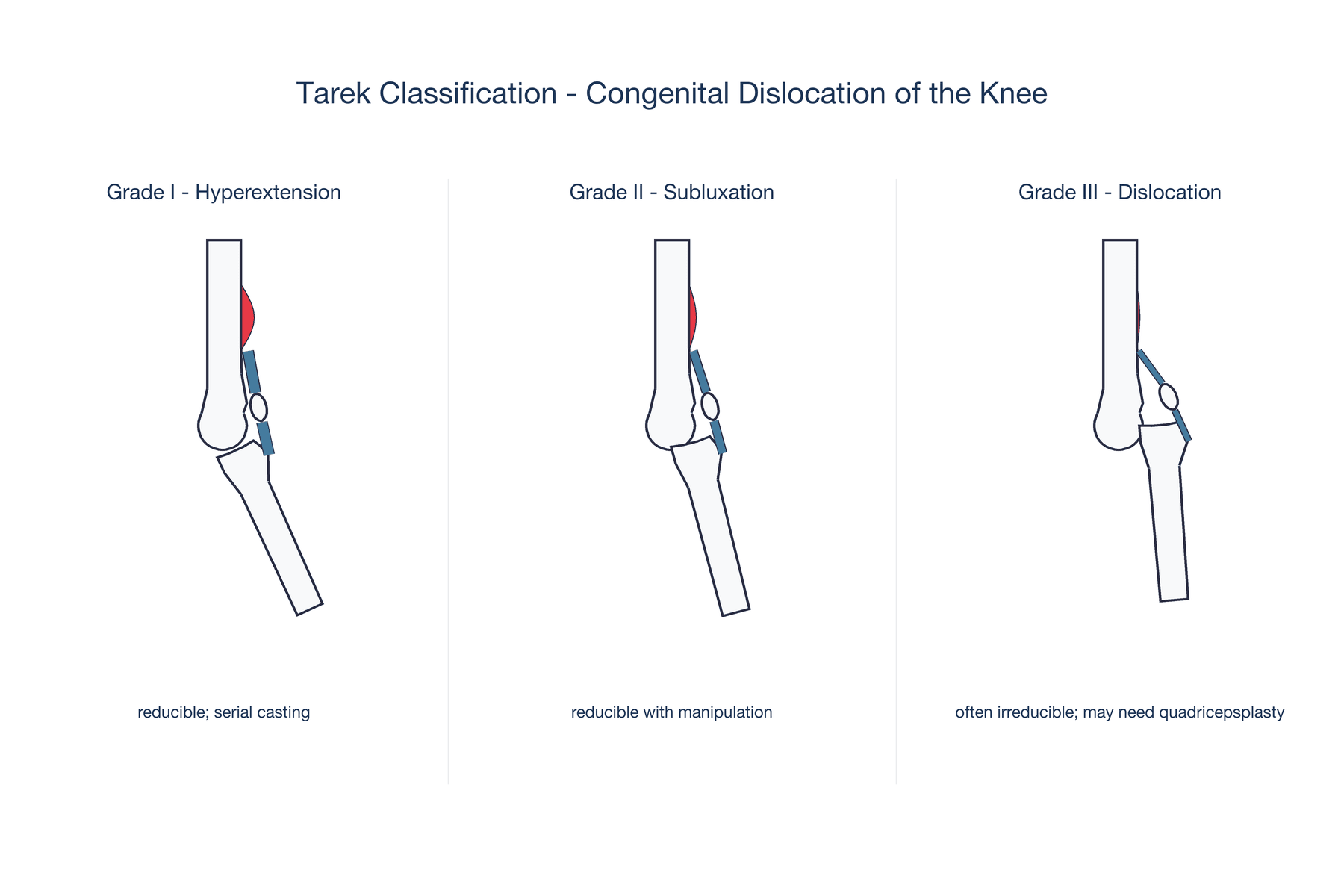 Tarek classification of congenital dislocation of the knee across three grades from hyperextension to complete dislocation