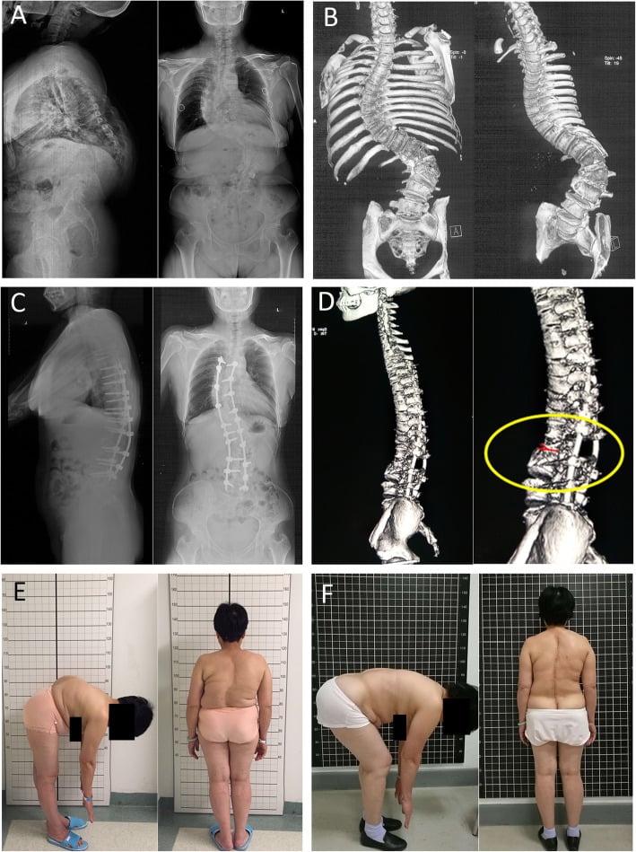 Congenital kyphoscoliosis surgical case with pre and post-operative imaging