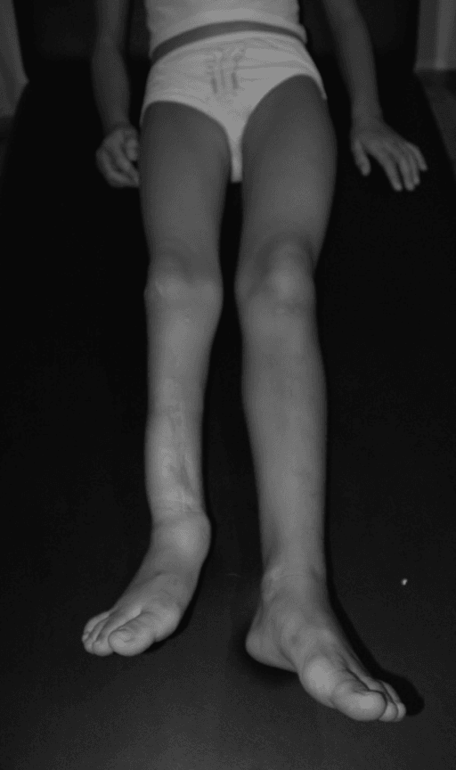 Clinical follow-up image after staged fibular hemimelia treatment