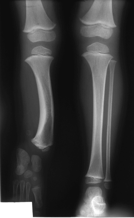 Radiographic presentation of fibular hemimelia in a child