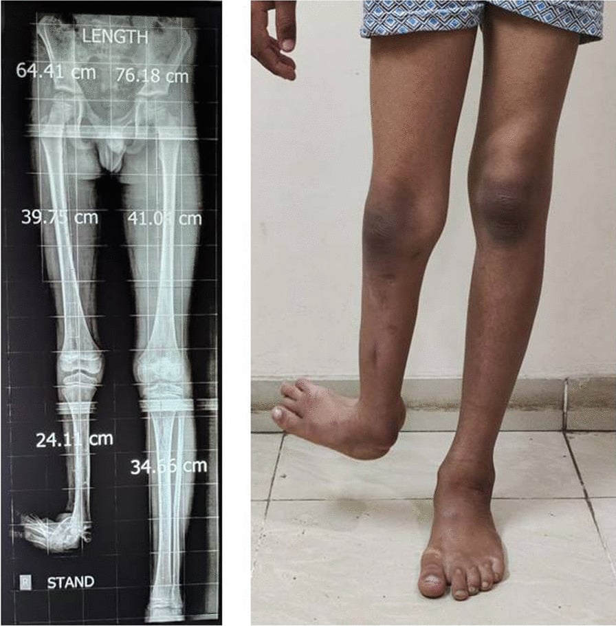 Standing scanogram of a child with right fibular hemimelia, femoral, tibial and total lengths printed for each limb, beside a clinical photograph of the child standing with the short right foot held off the floor.