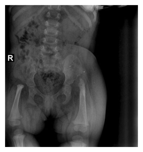 AP pelvis radiograph with an R marker showing bilateral short femurs whose proximal ends are not seated in the acetabula.