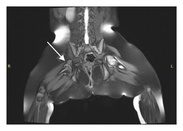 Coronal MRI of the pelvis in bilateral proximal femoral focal deficiency, with R and L markers and an arrow at the right hip.