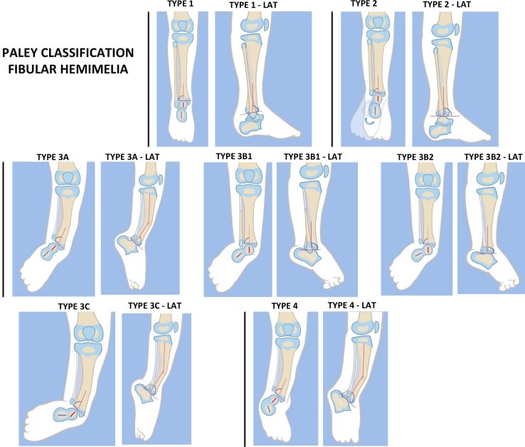 Paley classification schematic of fibular hemimelia showing Types 1, 2, 3A, 3B1, 3B2, 3C and 4, each drawn in a frontal and a lateral view.