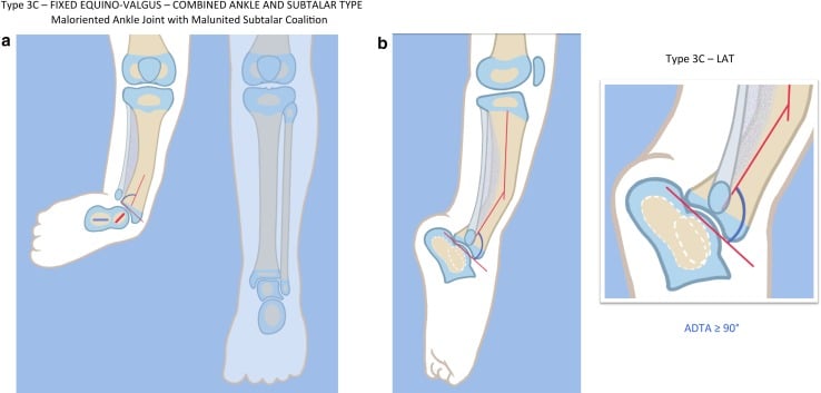 Schematic of Paley type 3C fibular hemimelia: frontal view of both legs (a), lateral view (b) and an inset lateral of the ankle, titled fixed equinovalgus, combined ankle and subtalar type, with a maloriented ankle joint and malunited subtalar coalition.
