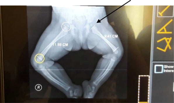 Frog-leg lateral radiograph of the pelvis with printed femoral lengths of 11.88 cm on the right and 9.41 cm on the left, an arrow marking the short left femur.