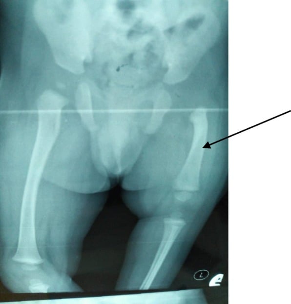 AP radiograph of the pelvis and thighs showing a short ossified left femoral remnant marked by an arrow beside a fully formed right femur.