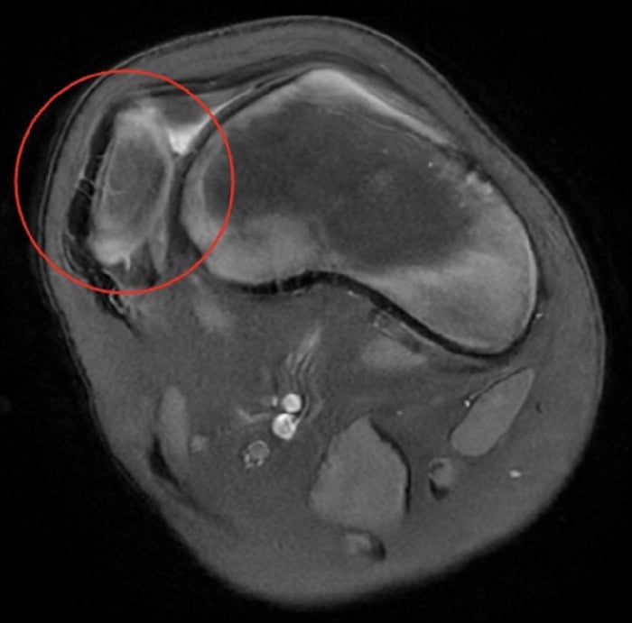 Axial MRI showing a laterally dislocated patella and shallow trochlear groove