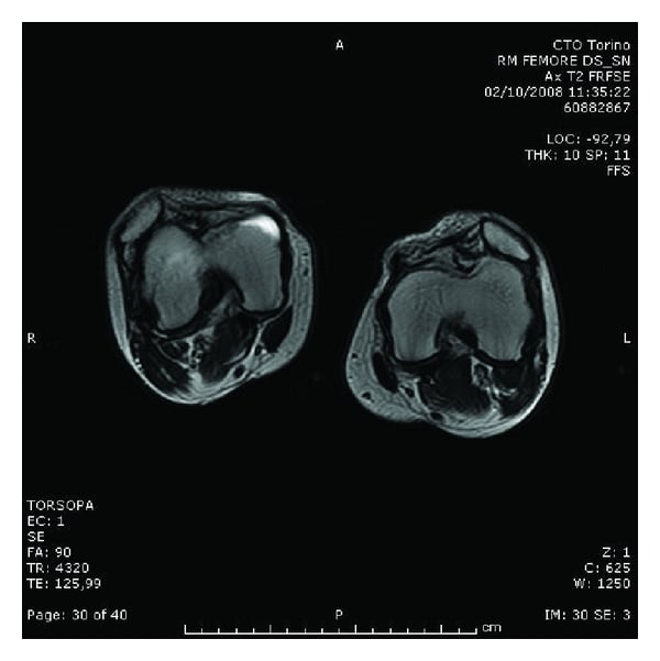 Axial MRI of both knees in extension showing bilateral lateral patellar dislocation and medial quadriceps hypoplasia