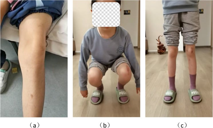 Preoperative lateral patellar prominence and postoperative squat and standing alignment in a child