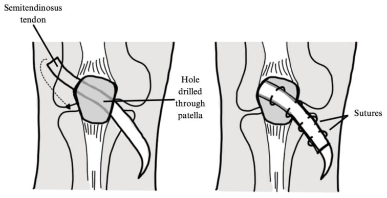 Diagram of Galeazzi semitendinosus tenodesis through the patella