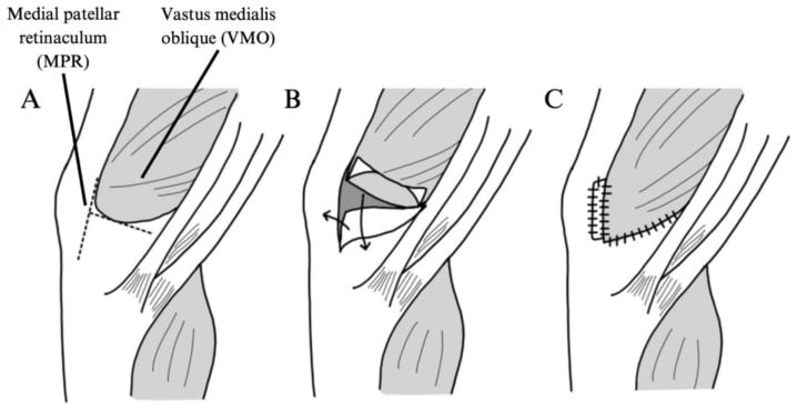 Diagram of medial retinaculum and vastus medialis advancement for patellar realignment