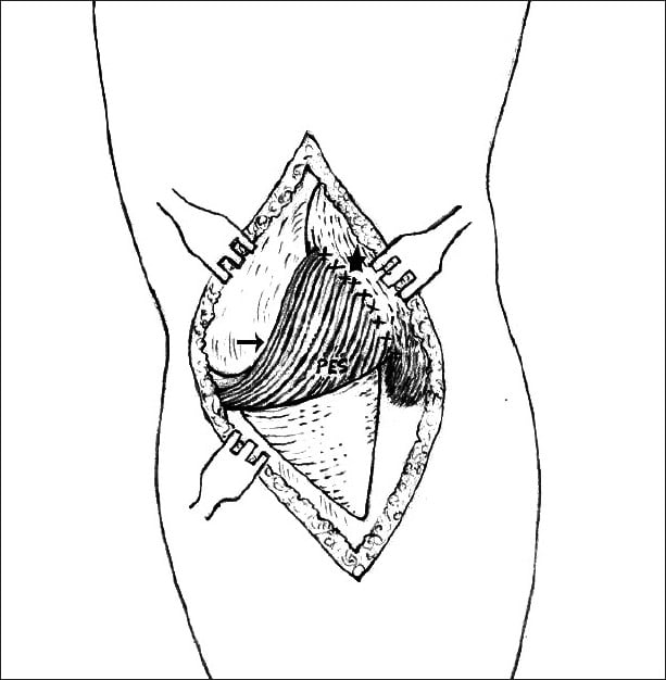 Line diagram of pes anserinus transposition used as a medial patellar stabiliser