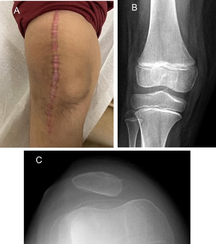 Healed postoperative knee with AP and sunrise radiographs showing central patellar alignment