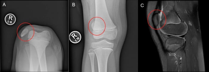 Preoperative sunrise and AP radiographs plus sagittal MRI showing congenital lateral patellar dislocation