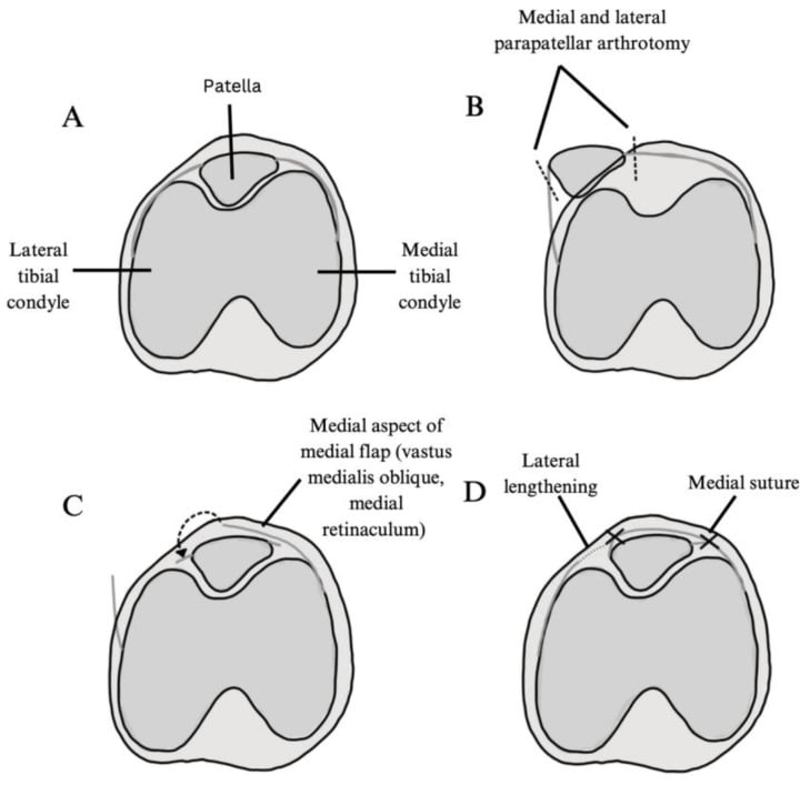 Axial schematic sequence of quadricepsplasty after wide lateral release for fixed patellar dislocation