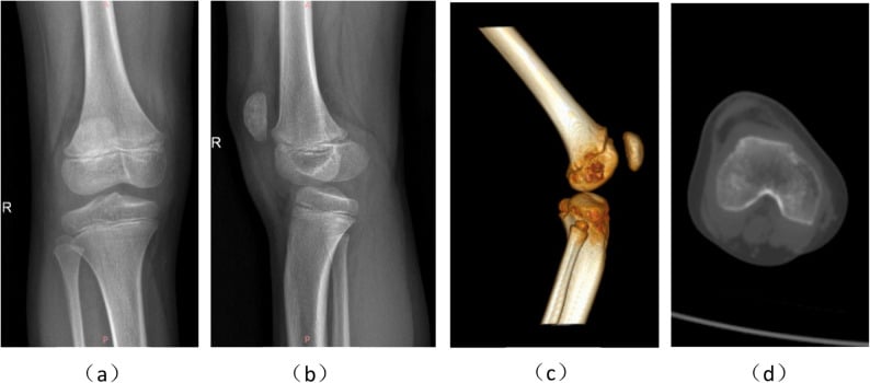AP and lateral radiographs with 3D and axial CT showing patella alta and lateral patellar dislocation in an immature knee