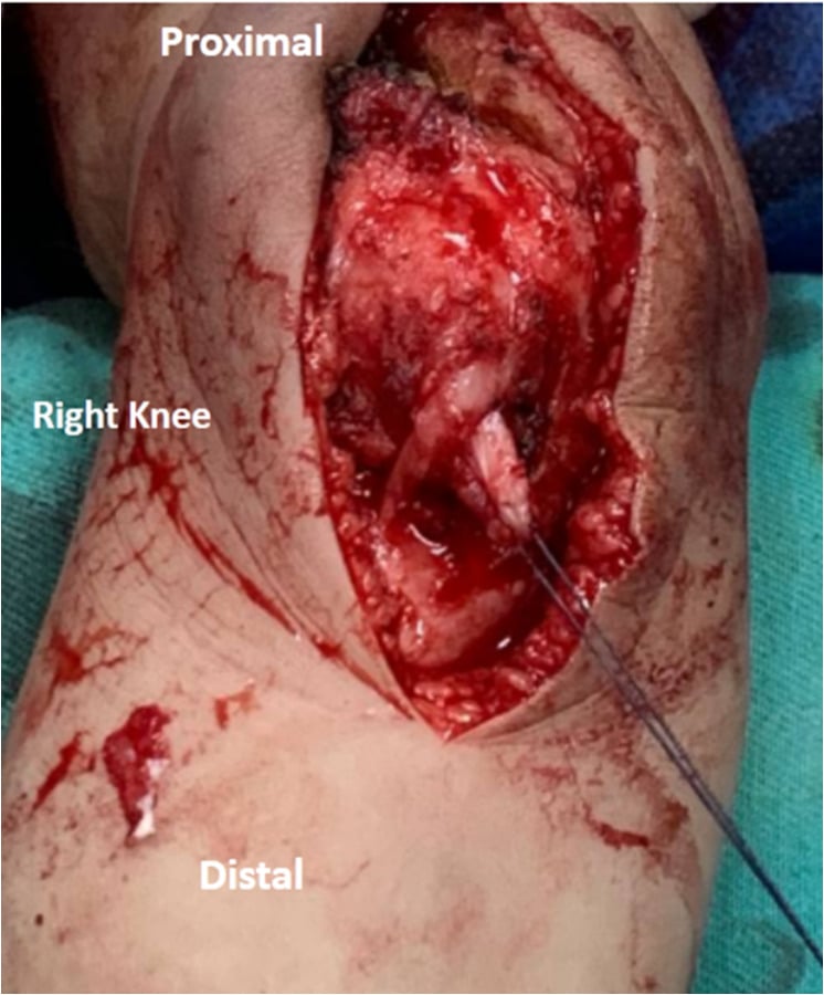Operative photograph of Roux-Goldthwait patellar tendon split and medial transfer