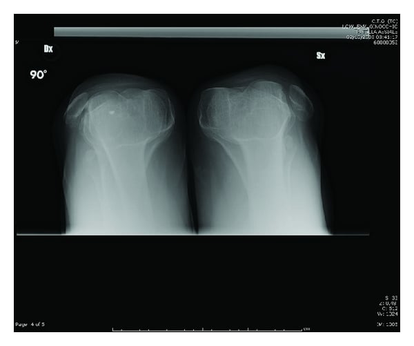 Skyline radiographs of both knees showing laterally dislocated patellae outside the trochlear groove
