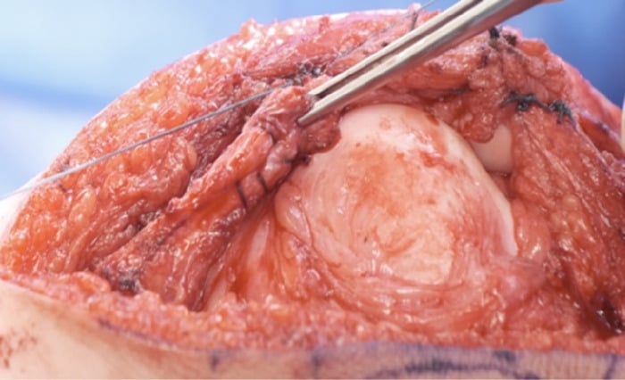 Operative photograph of end-to-end repair after quadriceps tendon Z-lengthening