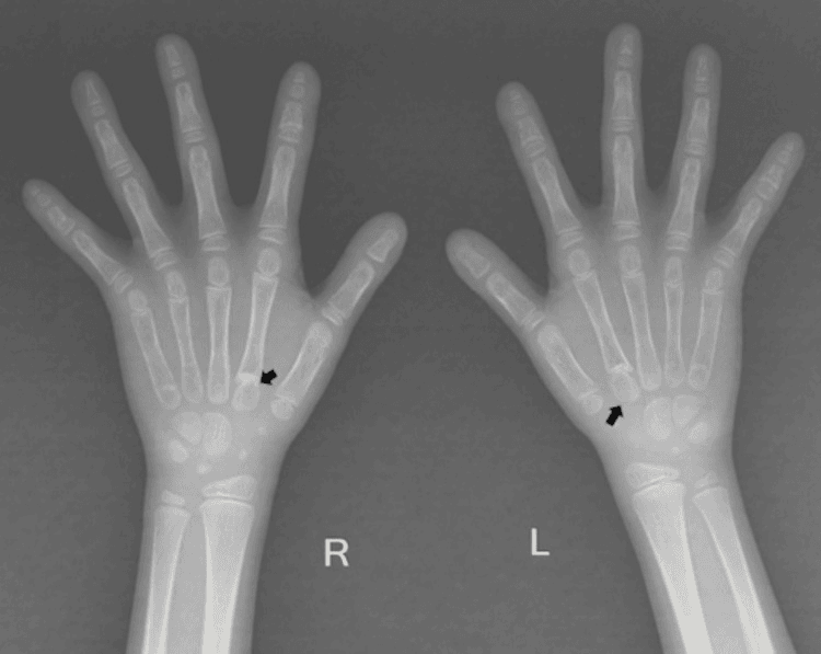 Hand radiographs in cleidocranial dysplasia showing short pointed distal phalanges and pseudoepiphyses of the index metacarpals