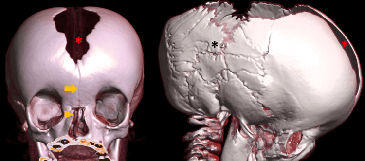Volume-rendered CT of the skull in cleidocranial dysplasia showing wormian bones, a persistent metopic suture and a wide-open anterior fontanelle