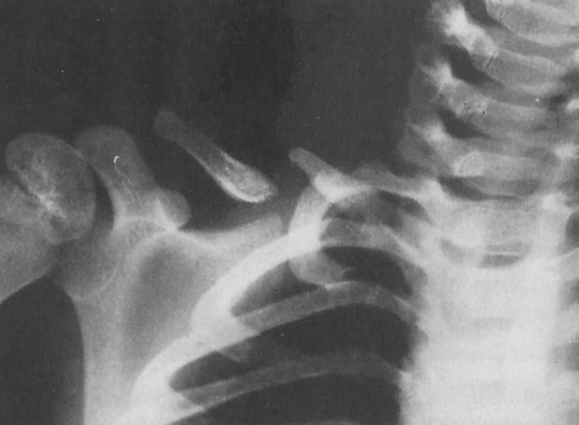 Radiograph of congenital pseudarthrosis of the right clavicle in a child showing a mid-clavicular gap with rounded sclerotic bone ends