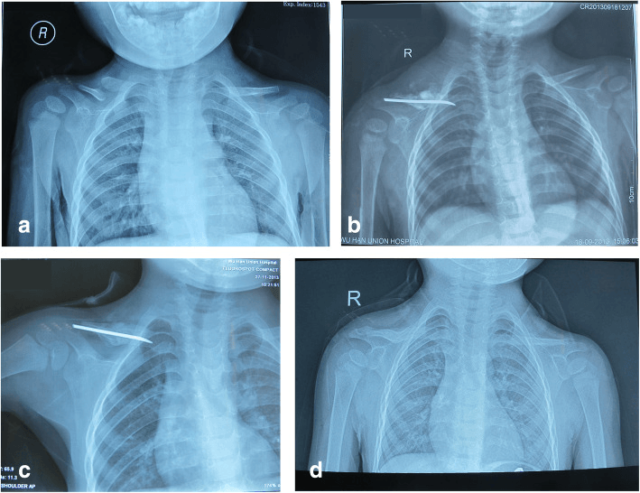 Serial clavicle radiographs showing pseudarthrosis resected and fixed with elastic stable intramedullary nailing, healed after nail removal