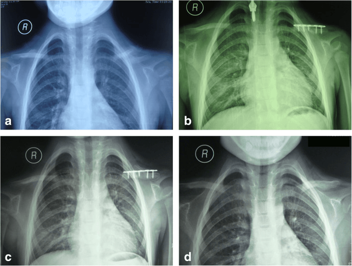 Serial clavicle radiographs showing congenital pseudarthrosis resected and reconstructed with an iliac crest autograft and plate, healing at 11 months