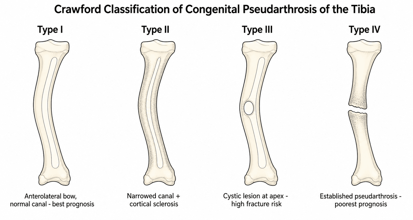 Diagram of the Crawford classification of congenital pseudarthrosis of the tibia, types I to IV.