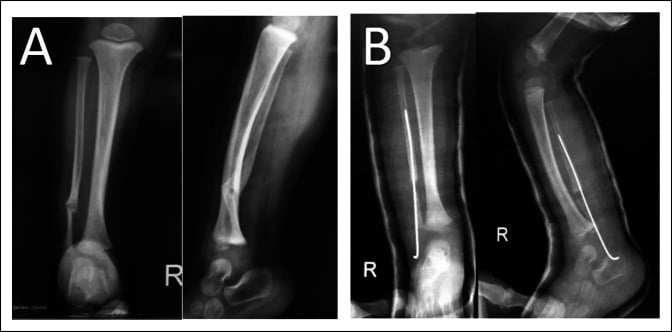 Radiographs of congenital pseudarthrosis of the fibula before and after periosteal flap surgery in an infant