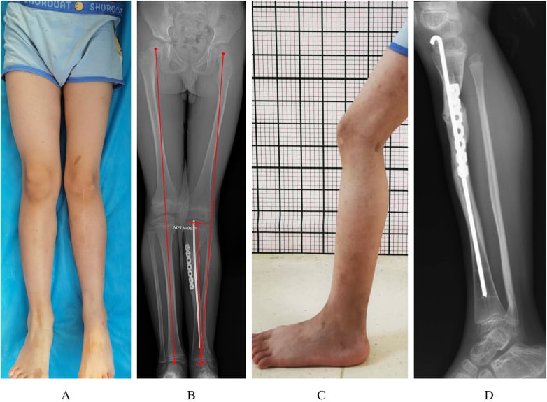 Clinical photographs and full-length radiographs at final follow-up showing near-equal limb lengths with mild genu valgum
