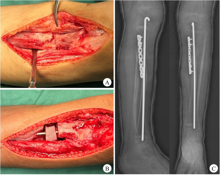 Intraoperative photographs of thickened fibrous periosteum at the pseudarthrosis site with postoperative rod and graft radiograph