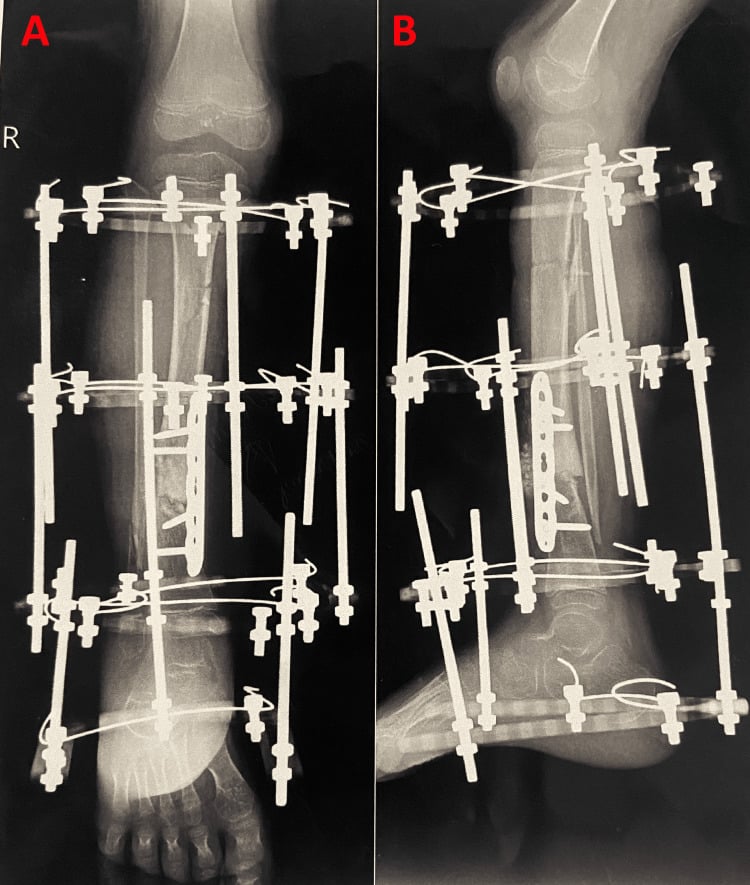 AP and lateral radiographs of a tibia stabilised in an Ilizarov circular frame
