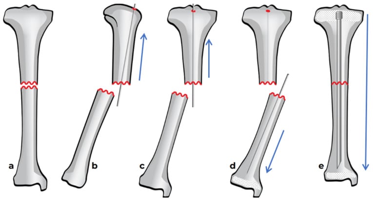 Technique diagram of intramedullary reaming and nail insertion through the osteotomy site
