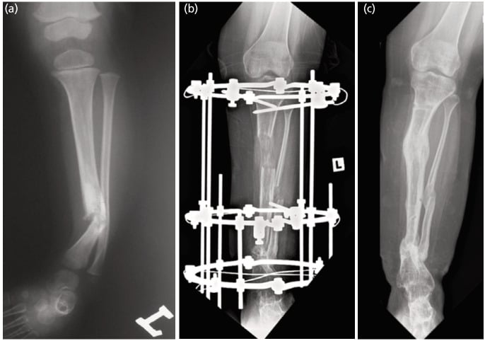Long-term tibial radiographs showing union after repeated surgery with residual distal tibial valgus and limb-length discrepancy