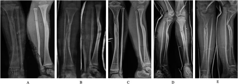 Serial tibial radiographs from first fracture through dysplasia, failed union and refracture in congenital pseudarthrosis