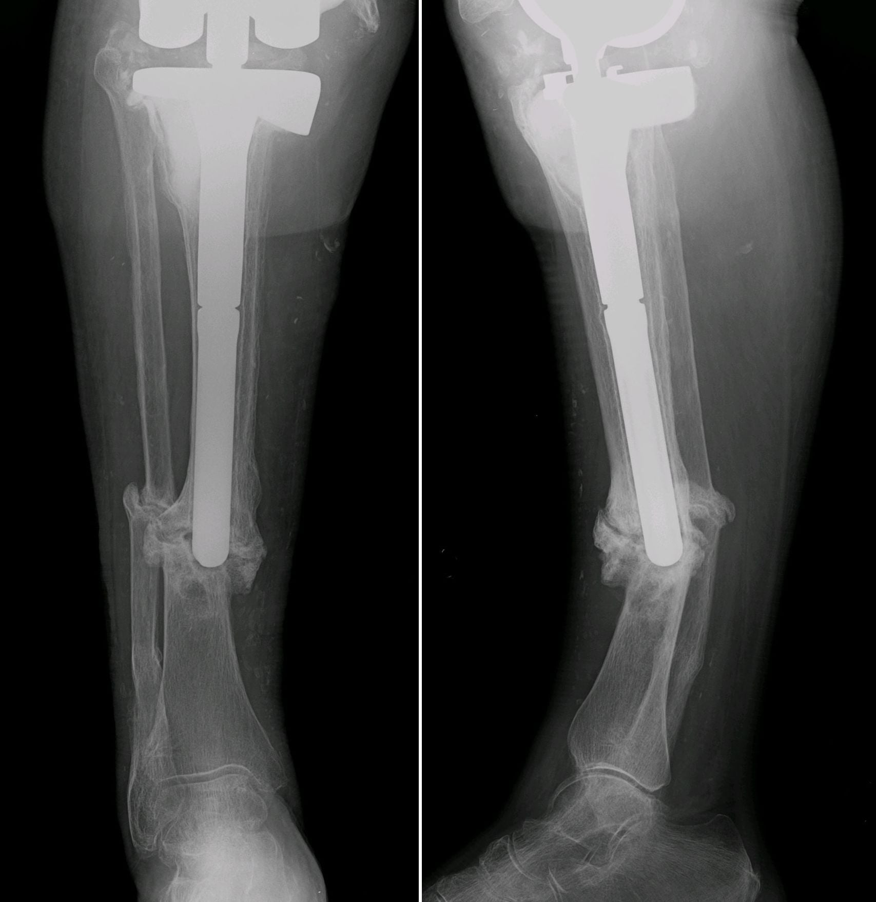AP and lateral radiographs of congenital pseudarthrosis of the tibia stabilised with a transankle intramedullary rod, showing the dysplastic distal-third pseudarthrosis.